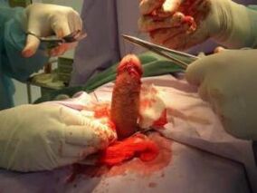 Operation zur Penisvergrößerung
